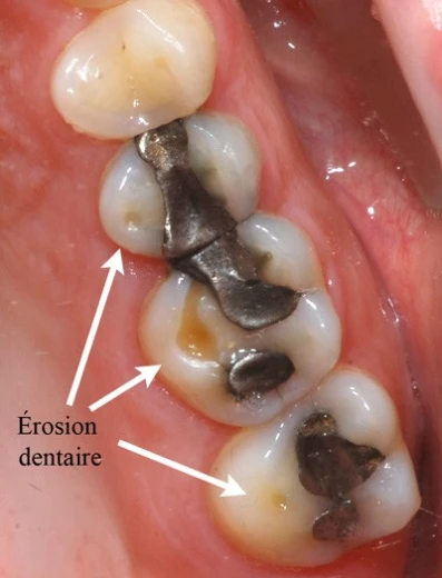 Érosion dentaire